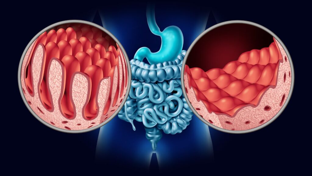 Medical diagram highlighting transmural inflammation, strictures, and tissue damage in the gastrointestinal tract and intestinal lining caused by Crohn's disease.